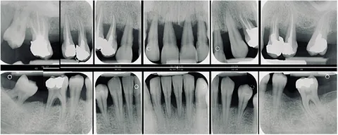 Minimally Invasive Treatment, Arrest, and Control of