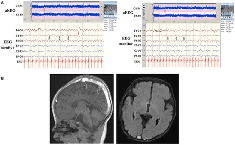 eeg 2011年 Simultaneous stereo-EEG and high-density scalp EEG