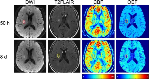 裁断済み　diffusion・perfusion MRI Automated MRI perfusion-diffusion mismatch estimation may be
