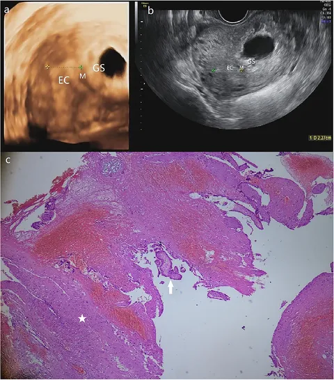 Disastrous Murmur (Austria) - Extra Uterine Pregnancy (EP