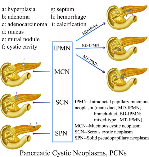 Frontiers | Cystic Neoplasms of the Pancreas: Differential