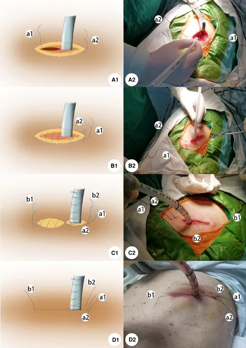呼吸器外科テキスト = Textbook of Chest Surgery :… Sabiston and Spencer Surgery of the Chest: 2-Volume Set