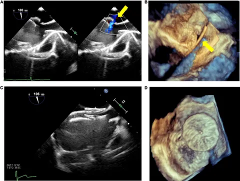 ECHOCARDIOGRAPHY IN CONGENITAL HEART DISEASE MADE SIMPLE
