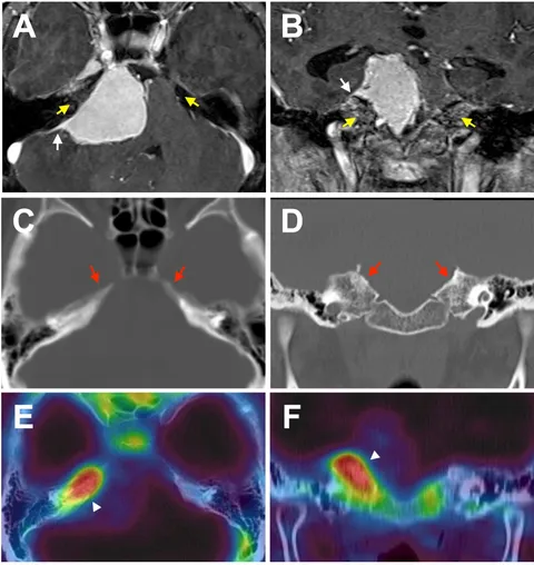 Frontiers | Bone Invasive Meningioma: Recent Advances and