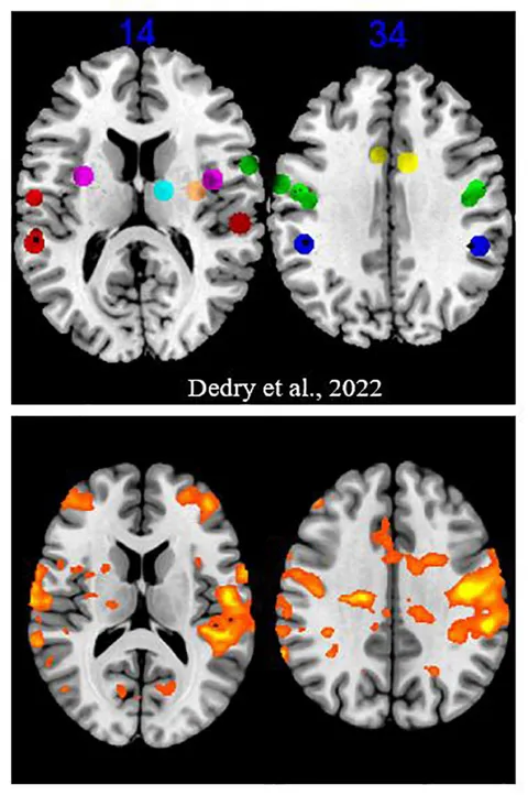 Frontiers | Brain adaptation following various unilateral Frontiers | Brain adaptation following various unilateral