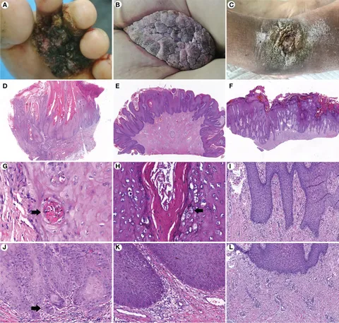 Viscera Infest – Verrucous Carcinoma（帯付） fonc-12-953932-g003.jpg