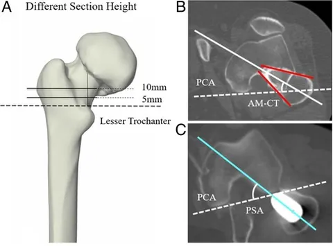 Surgical Techniques of Using Direct Anterior Approach and
