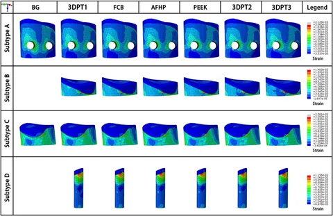 Multiplanar correction of proximal tibial recurvatum