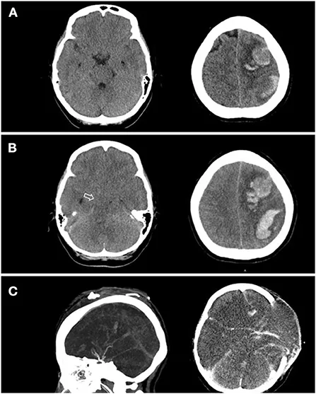 A11290613]Thrombosis Medicine Vol.7 No.4(2017 特集:外傷性