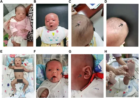 Frontiers | Clinical manifestations and genetic analysis of
